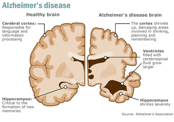 Ketones and the Aging Brain