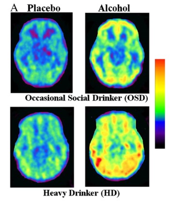 Ketogenic Diet in Substance Abuse