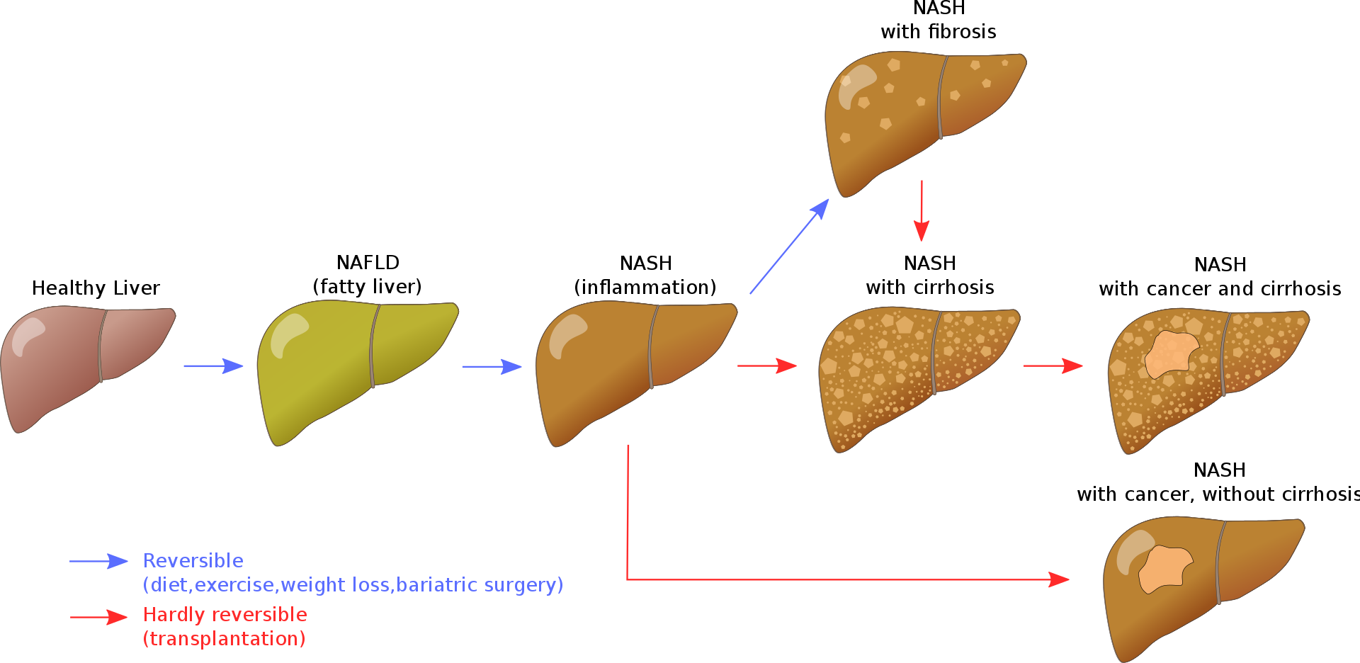 Non alcoholic fatty liver. Неалкогольная жировая болезнь печени стадии. Неалкогольный цирроз печени. Неалкогольная жировая болезнь печени (НАЖБП).